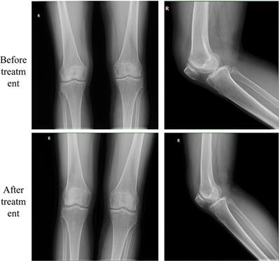 Case report: Electroacupuncture for acute pain flare-up of knee osteoarthritis